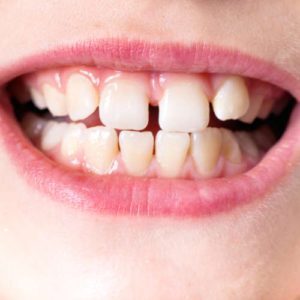 ¿cuál es la causa del hueco en los dientes delanteros de su hijo?