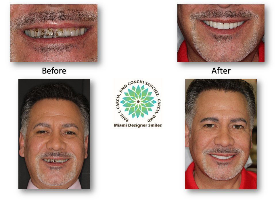 Fotografías de antes y después de los dientes de un hombre tomadas por un dentista cosmético de Miami Designer Smiles.