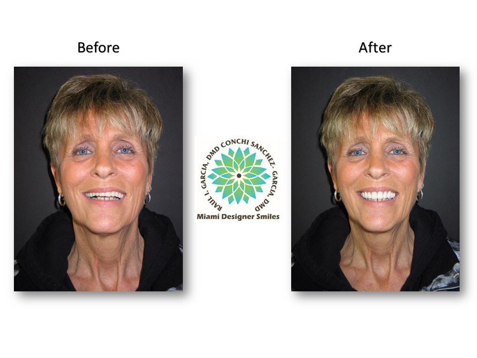 Fotos de antes y después de los dientes de una mujer que muestran el trabajo transformador de Miami Designer Smiles.