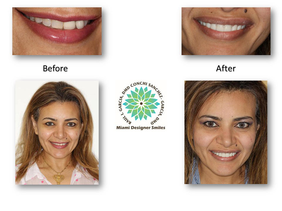 Fotos de antes y después de los dientes de una mujer transformados por el Dr. Raúl García, dentista cosmético.