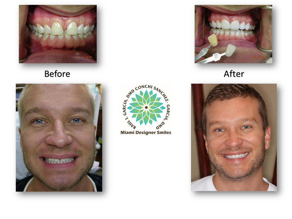 Imágenes de antes y después de los dientes de un hombre transformados por la Dra. Conchi García, dentista cosmética.