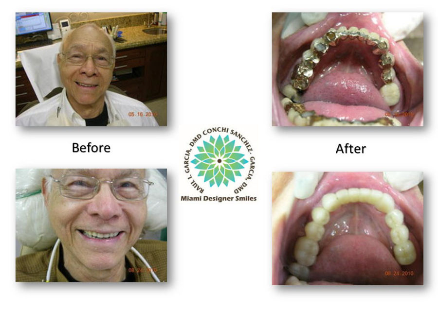 Controlled Arch Braces Orthodontics Miami Coral Gables
