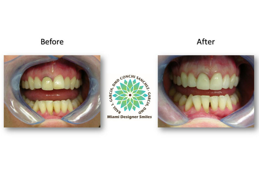 Porcelain Restorations Porcelain Dental Inlays/ Onlays Miami