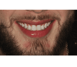 Un primer plano de la Dra. Conchi García con barba y lápiz labial rojo en Miami Designer Smiles.