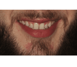 Un primer plano de la boca de un hombre con barba en Miami Designer Smiles.