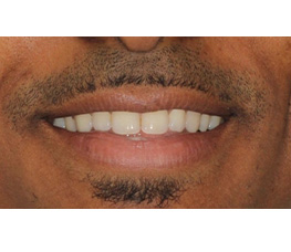 Los dientes de un hombre antes y después de un tratamiento de blanqueamiento dental.