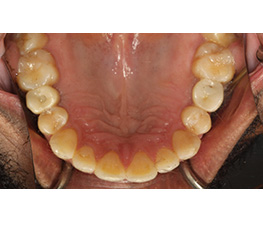 La boca de un hombre con aparatos de ortodoncia.