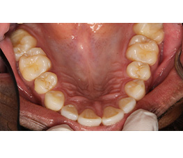 La boca de un paciente después de someterse a un tratamiento controlado con aparatos ortopédicos.