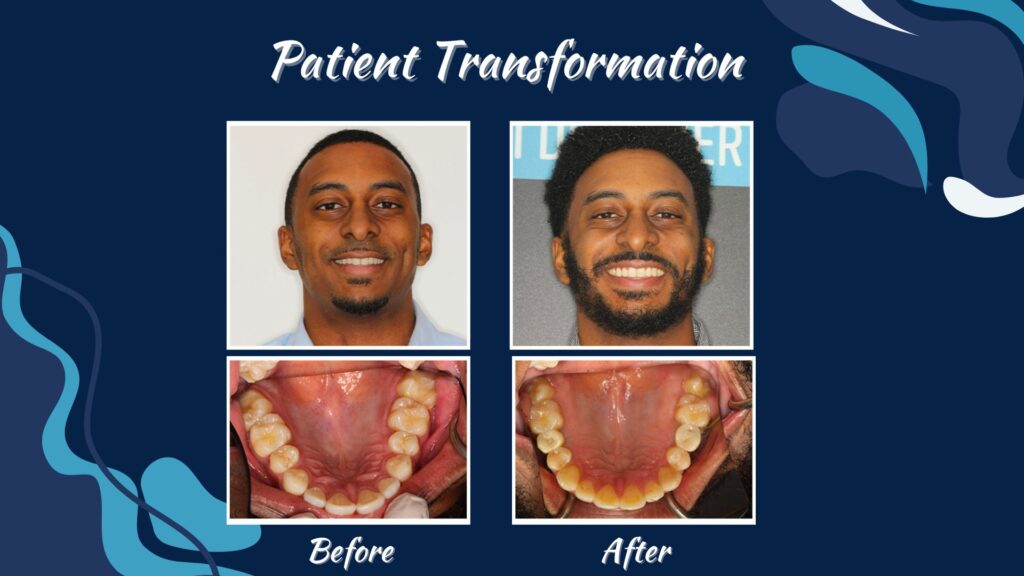 Side-by-side photos show a man’s face and teeth before and after dental treatment, highlighting straighter teeth, improved alignment, and a remarkable smile transformation.
